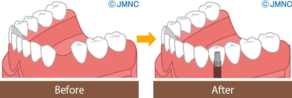 インプラント治療